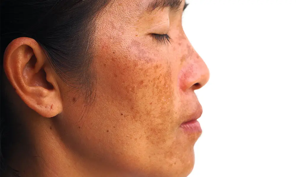 Beyond Aesthetics: Uneven Skin Tone: Issues in Jacksonville