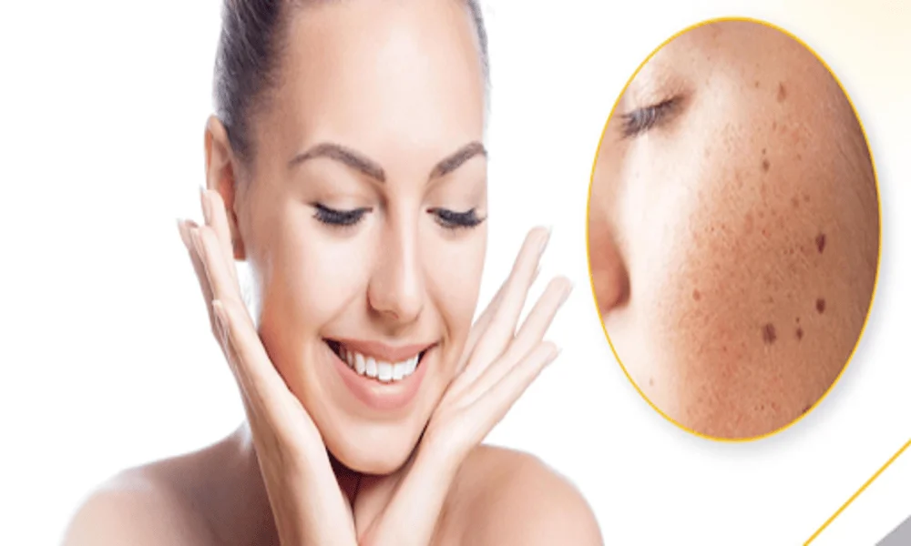 Post-Inflammatory Hyperpigmentation: A Philadelphia Teen’s Guide
